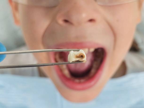 Best Pediatric Emergency Dentist in Redlands, CO